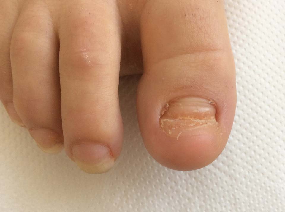 'Toe Nail Reconstruction' - Prosthetic Toe Nail
